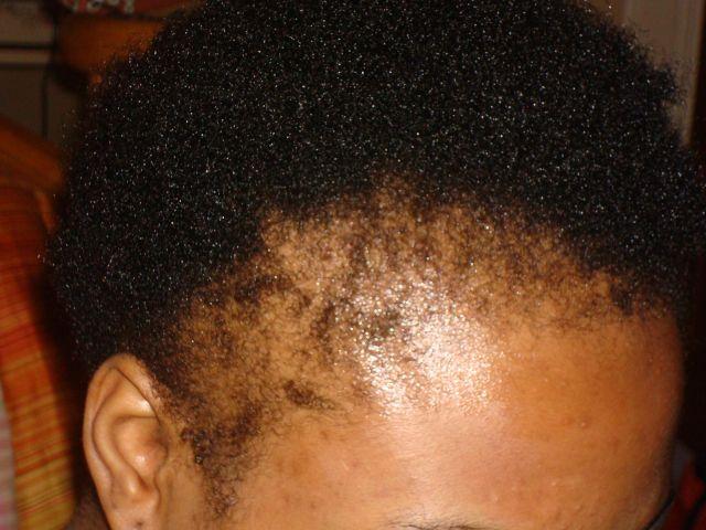 telogen-effluvium-alopecia-traction-hairloss-causes-solution-style-rave