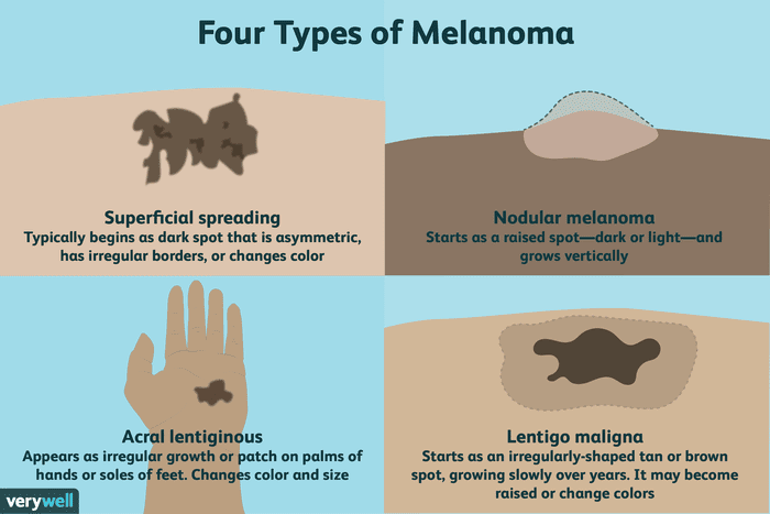 skin-cancer-melanoma-black-people